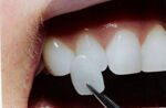 Как убрать «щель» между зубами без брекетов?!